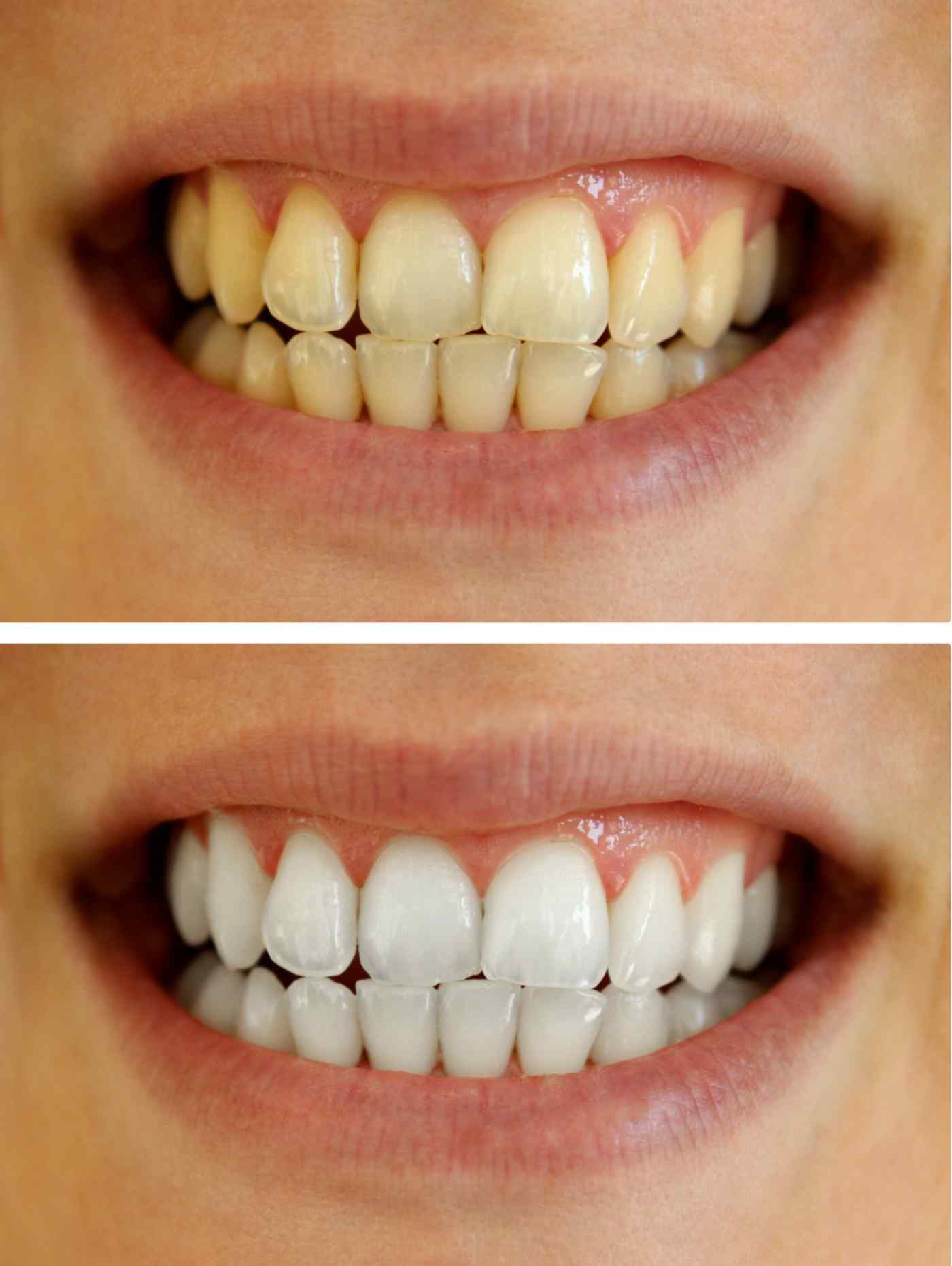 Bleaching vorher nachher Bild