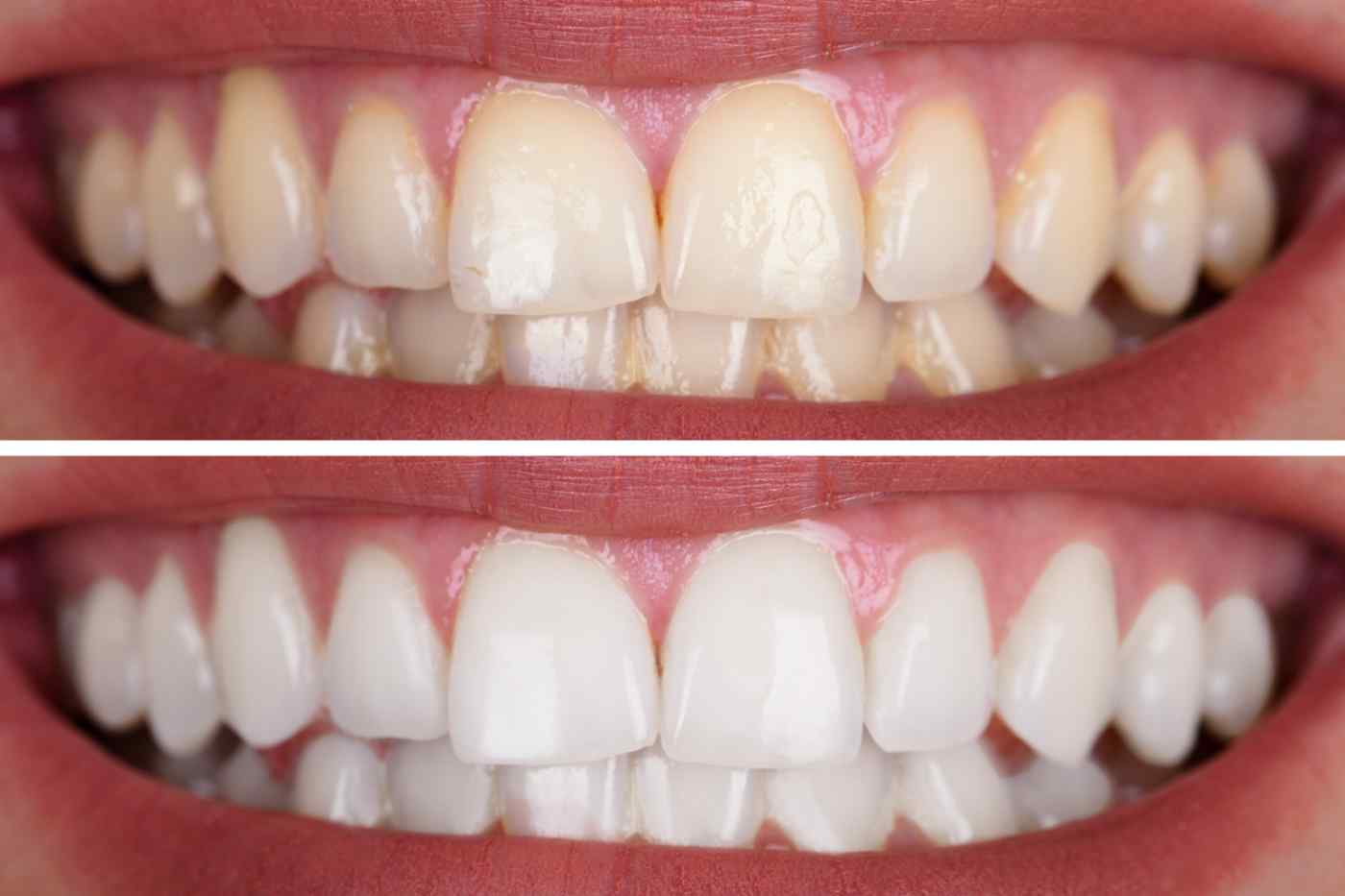 Bleaching vorher nachher Bild