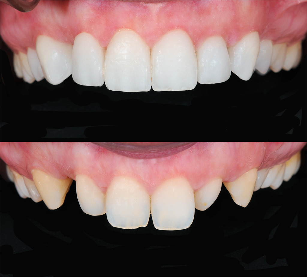 Veneer Behandlungsfall vorher nacher