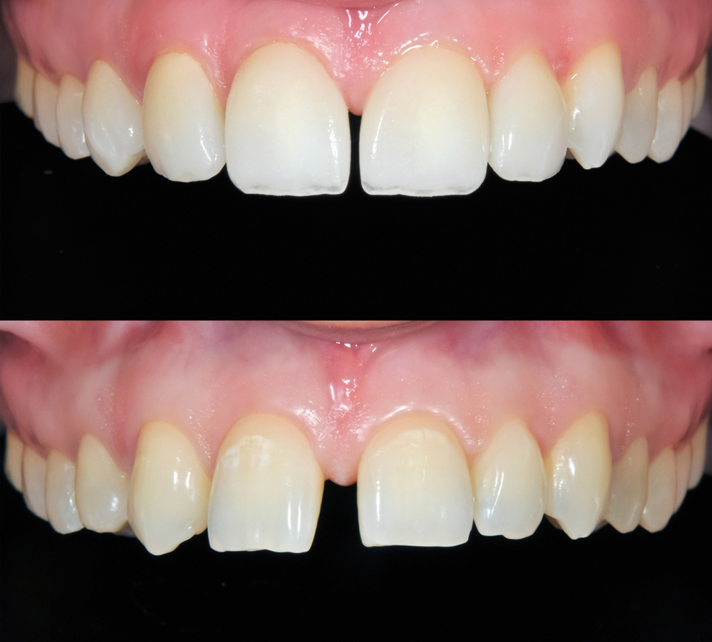 Veneer Behandlungsfall vorher nacher