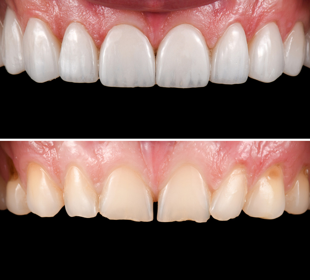 Veneer Behandlungsfall vorher nacher