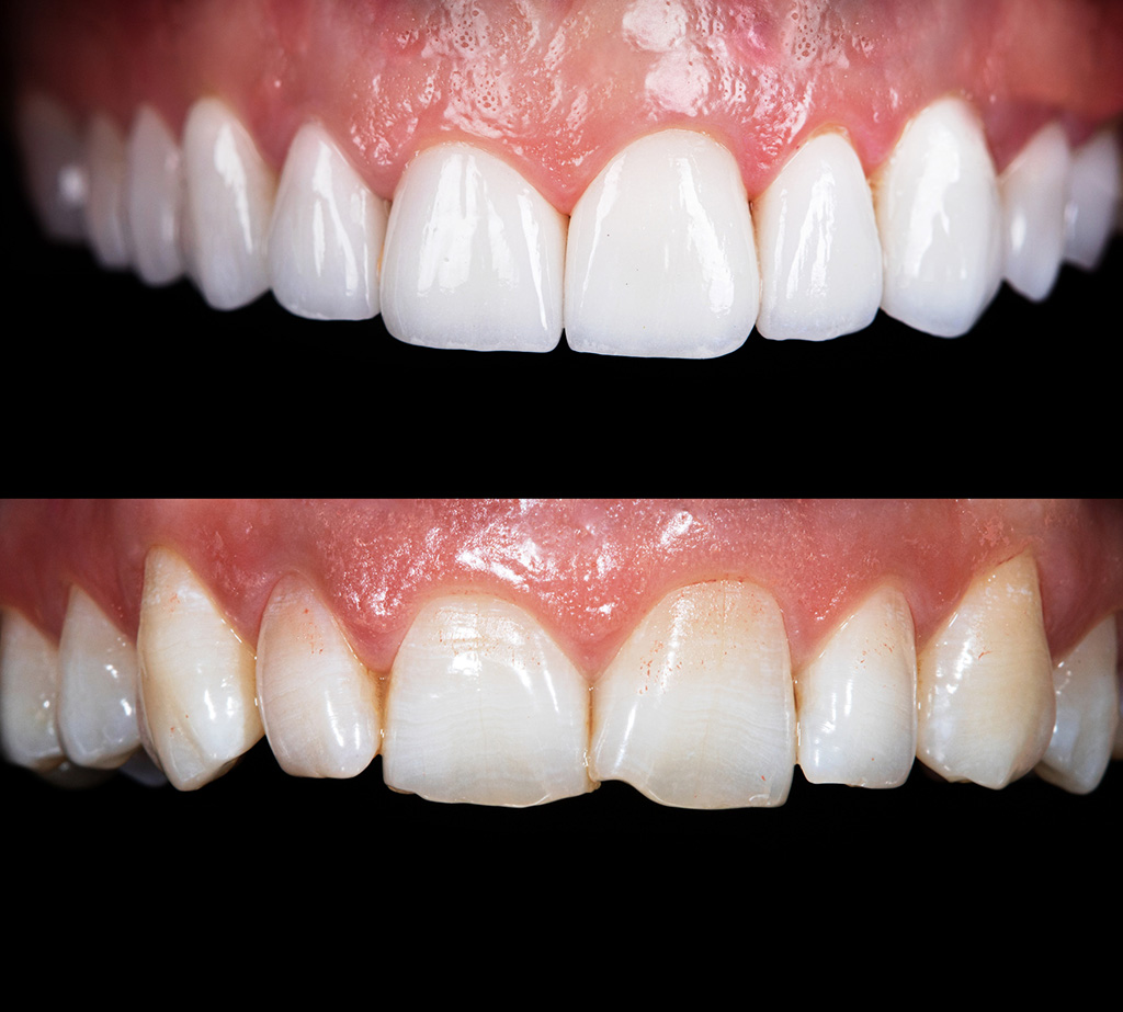 Veneer Behandlungsfall vorher nacher