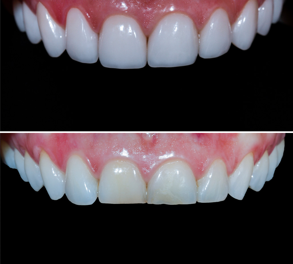 Veneer Behandlungsfall vorher nacher
