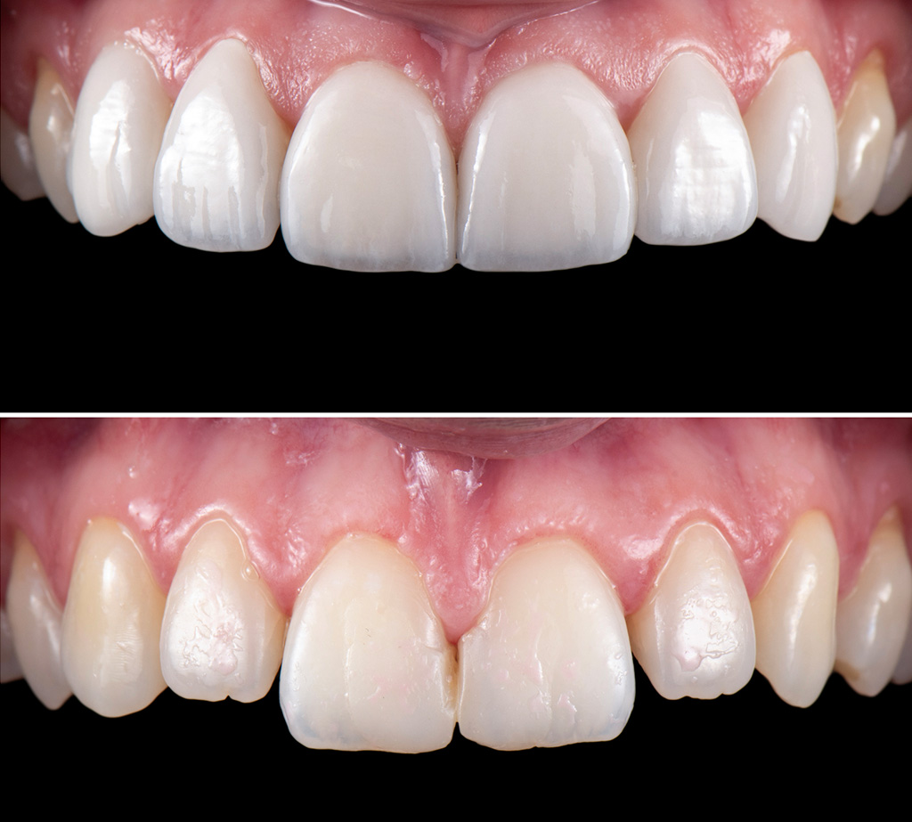 Veneer Behandlungsfall vorher nacher
